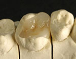 Inlays